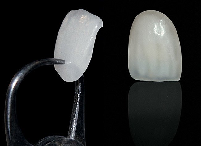 Facetas em Resina vs. Lentes de Contato em Porcelana: Escolhendo a Melhor Opção para o Seu Sorriso