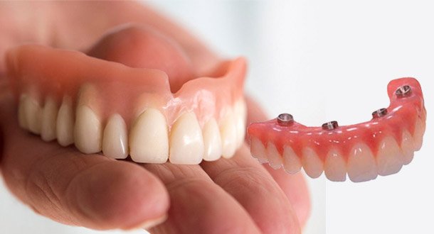 Protocolo e a Dentadura: Qual é a Melhor Opção para Você?